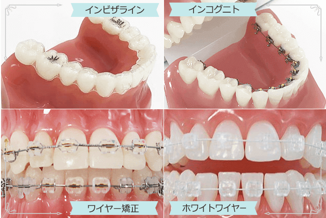 矯正装置の種類