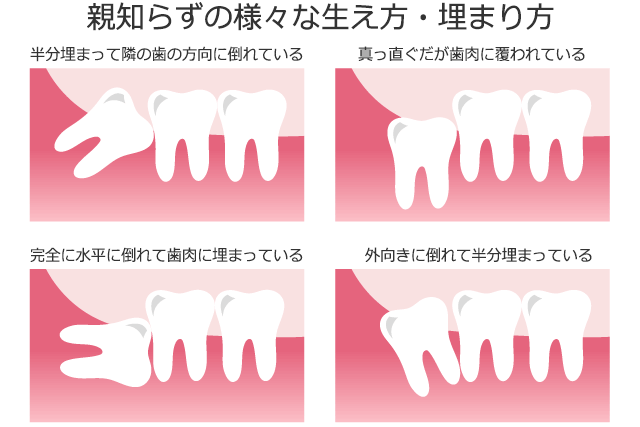 親知らずの様々な生え方・埋まり方