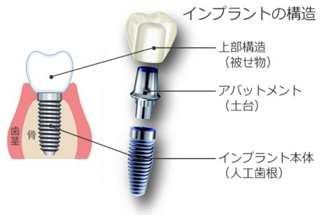 インプラントが動いてる。ぐらつくのはなぜ？