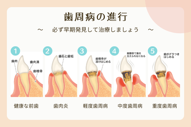 歯周病の進行