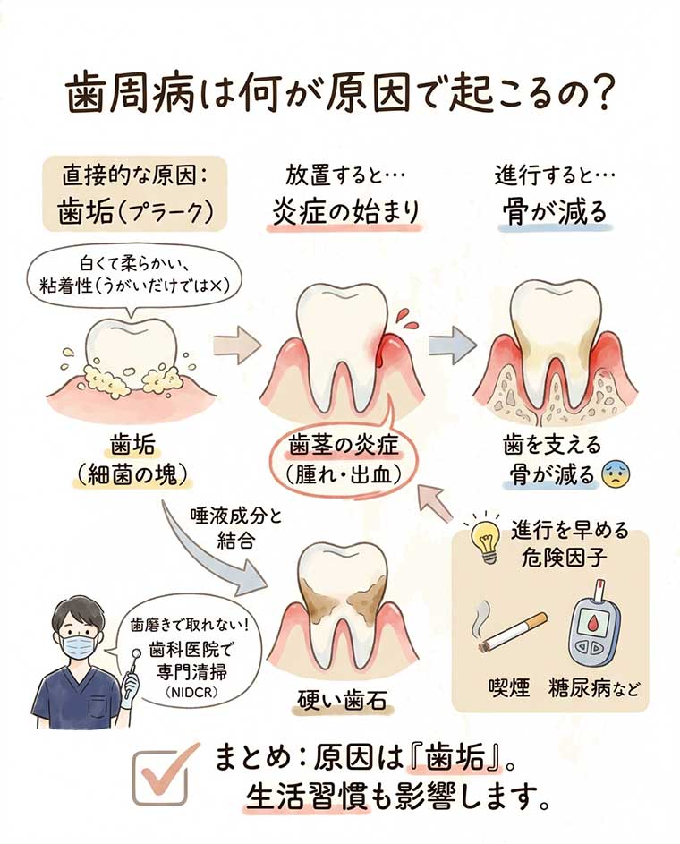 歯周病は何が原因で起こるの？の図解