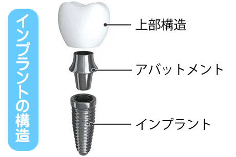 インプラントの構造