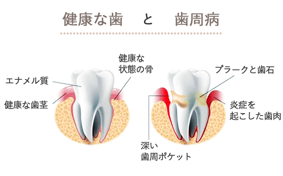 健康な歯と歯周病