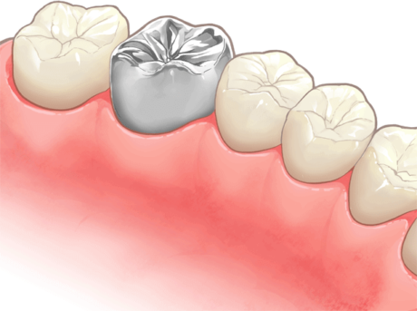 銀の被せ物（クラウン）