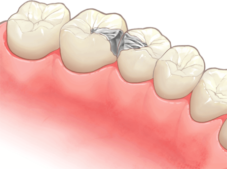 銀の詰め物（インレー）