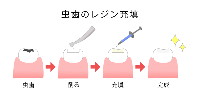 虫歯のレジン充填