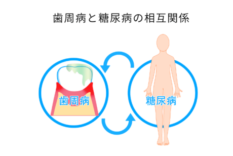 歯周病と糖尿病の相互関係