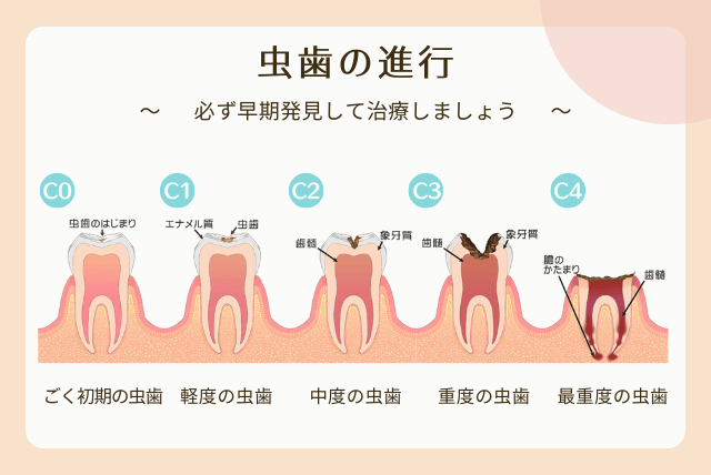 虫歯の進行