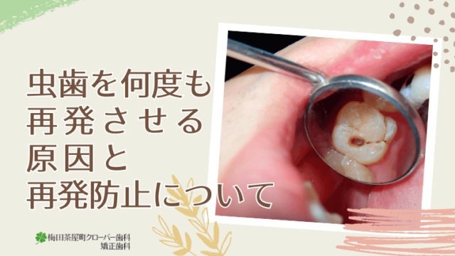 虫歯を何度も再発させる原因と再発防止について
