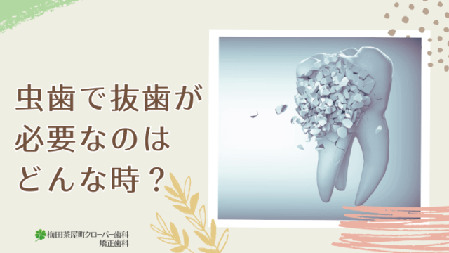 虫歯で抜歯が必要なのはどんな時？