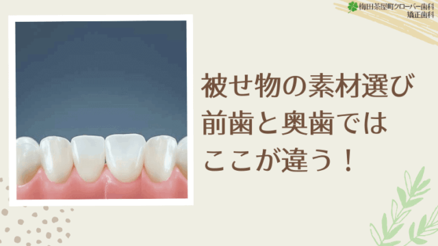 被せ物の素材選び　前歯と奥歯ではここが違う！
