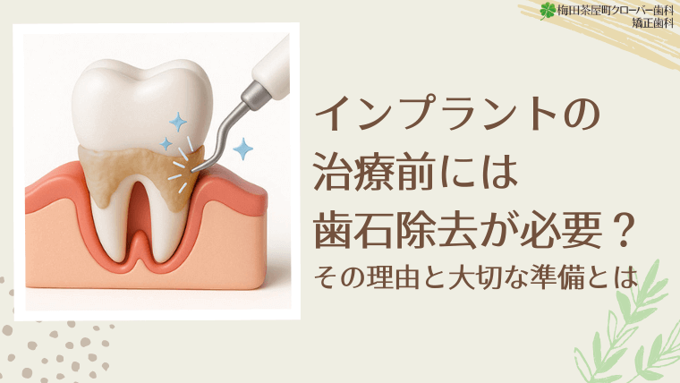 インプラントの治療前には歯石除去が必要？