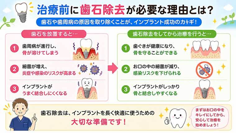 治療前に歯石除去が必要な理由とは？の図解