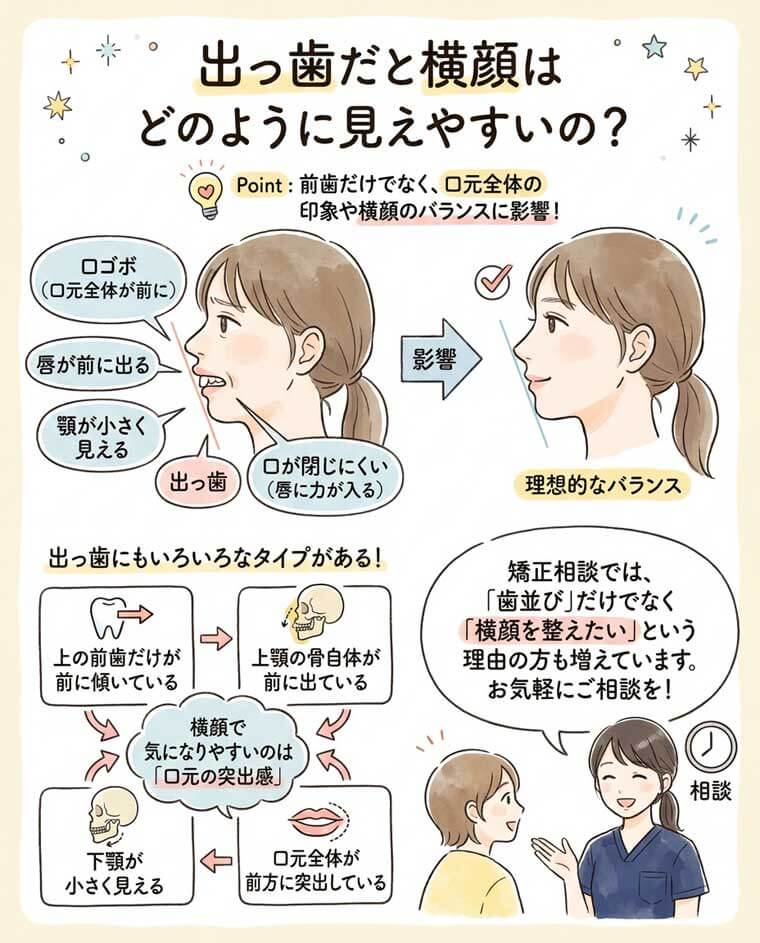 出っ歯だと横顔はどのように見えやすいの？の図解