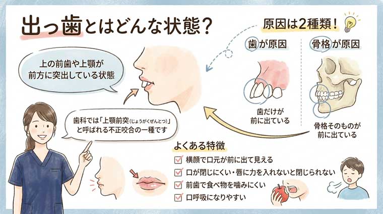 出っ歯とはどんな状態？の図解