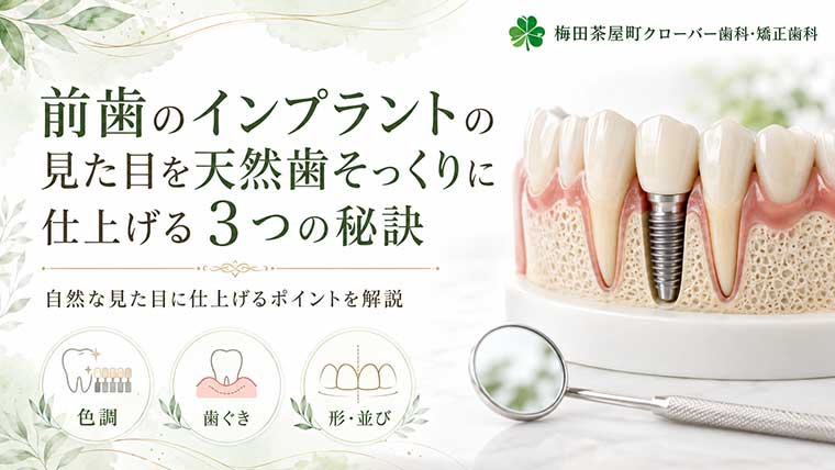 前歯のインプラントの見た目を天然歯そっくりに仕上げる3つの秘訣とは？