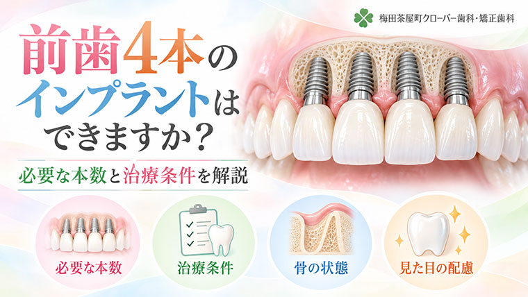 前歯4本のインプラントはできますか？必要な本数と治療条件を解説