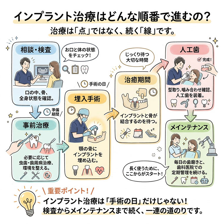 インプラント治療はどんな順番で進むの？の図解
