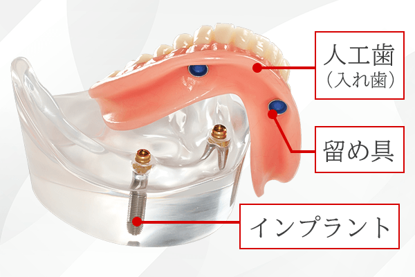 インプラントオーバーデンチャーのイメージ